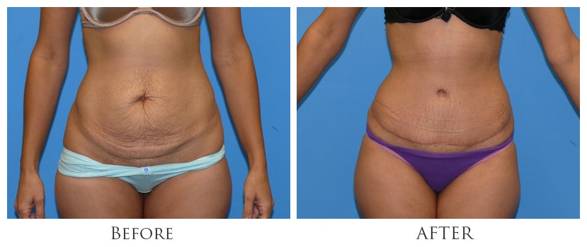 Experience Transformation: Tummy Tuck Procedures in Miami post thumbnail image