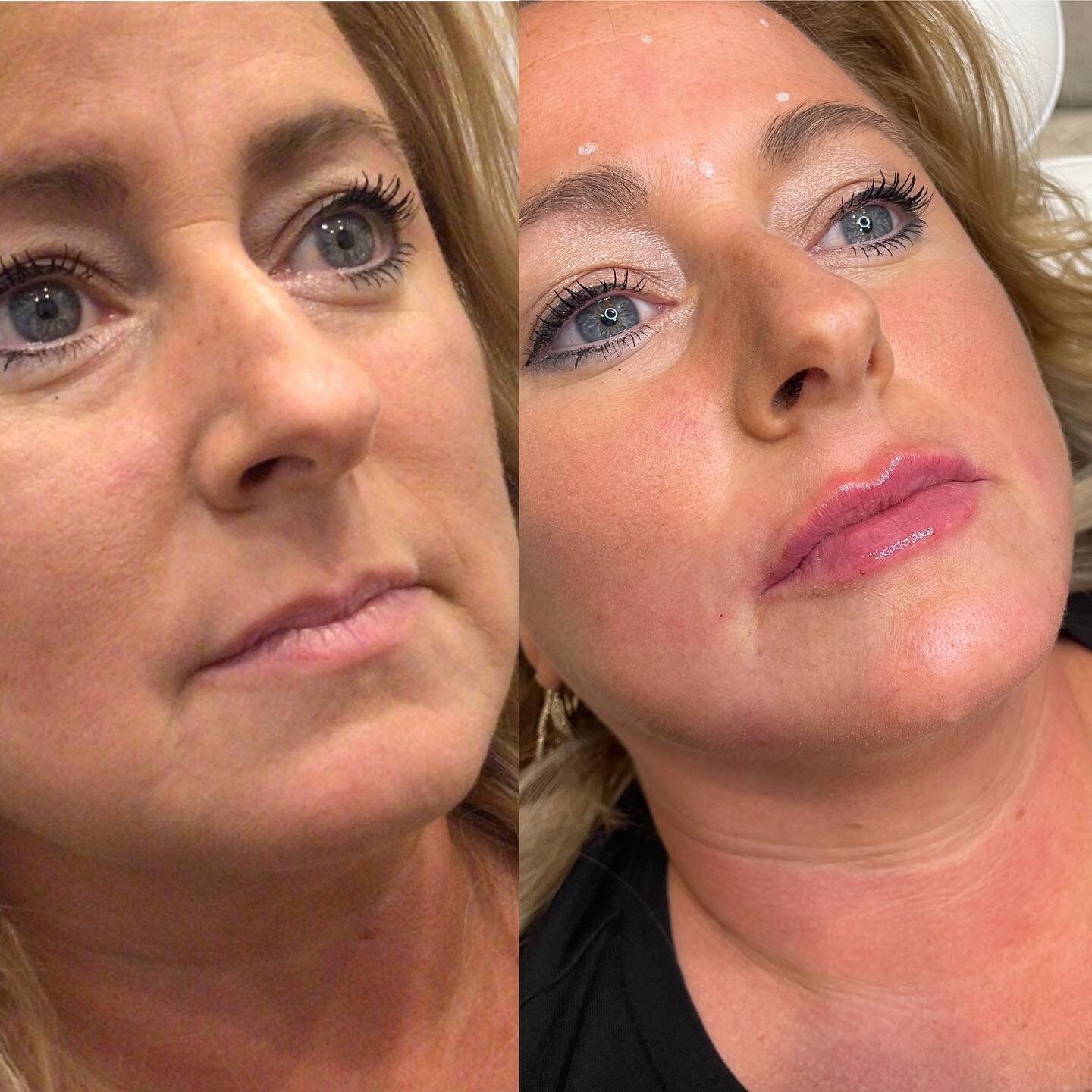 Beyond Attractiveness: Other Restorative Uses of Botox post thumbnail image